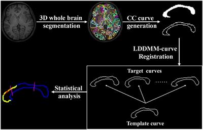 A Deformation-Based Shape Study of the Corpus Callosum in First Episode Schizophrenia